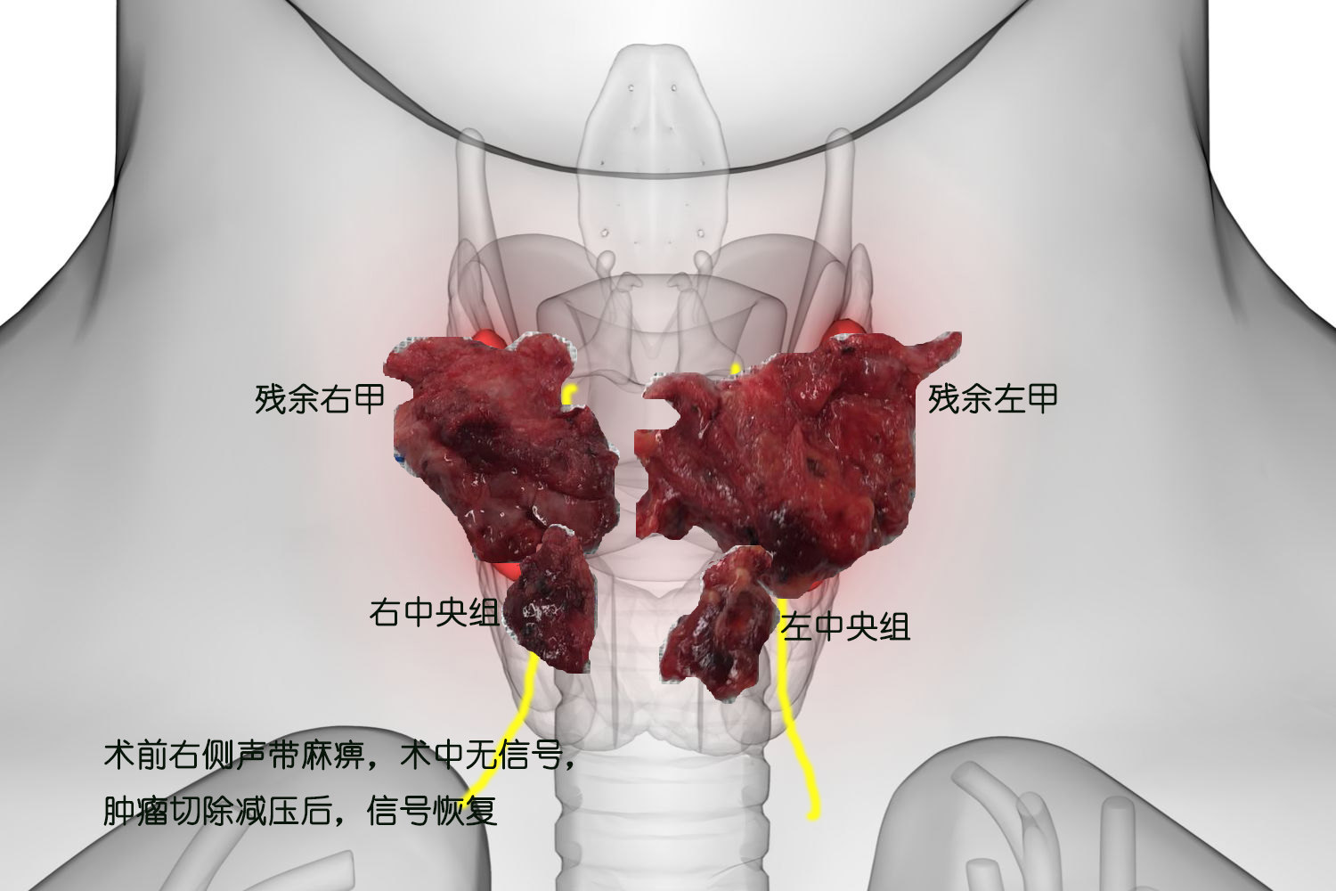 什么叫甲功能异常_异常功能亢进是什么意思_甲功异常是什么意思