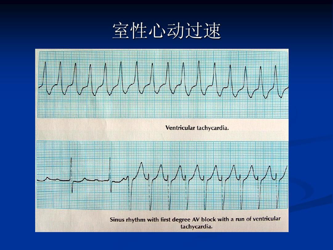 阵发性室上性心动过速的治疗_阵发性室性心动过_阵发性房性心动