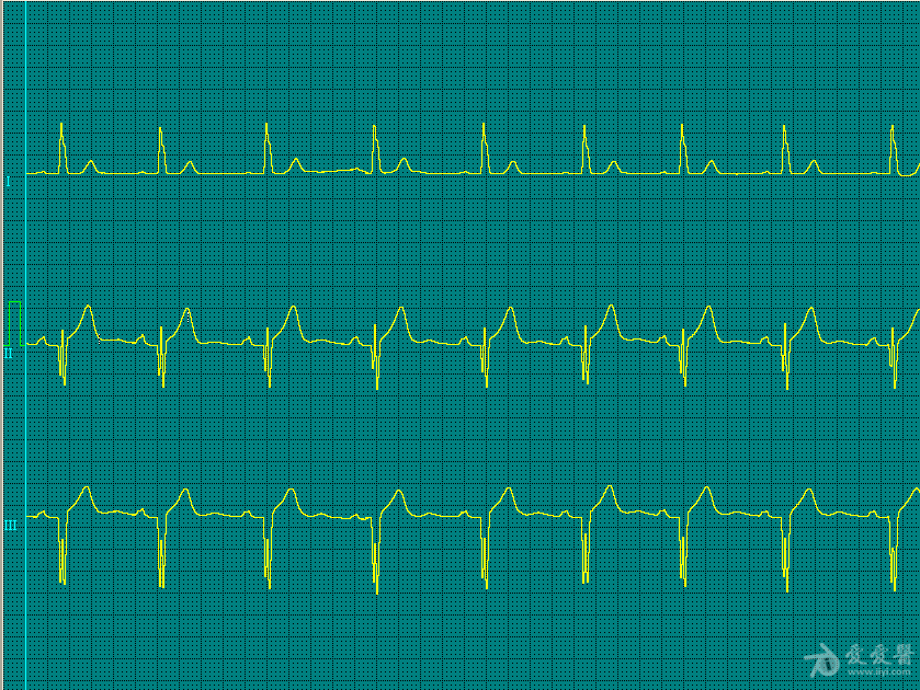 心电图q波异常能恢复吗_心电图异常q波下壁心肌梗塞_异常q波