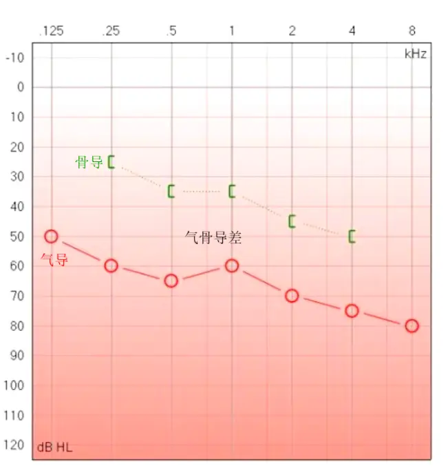 气骨导差正常值是多少_骨气导差大_骨气导差多少是正常