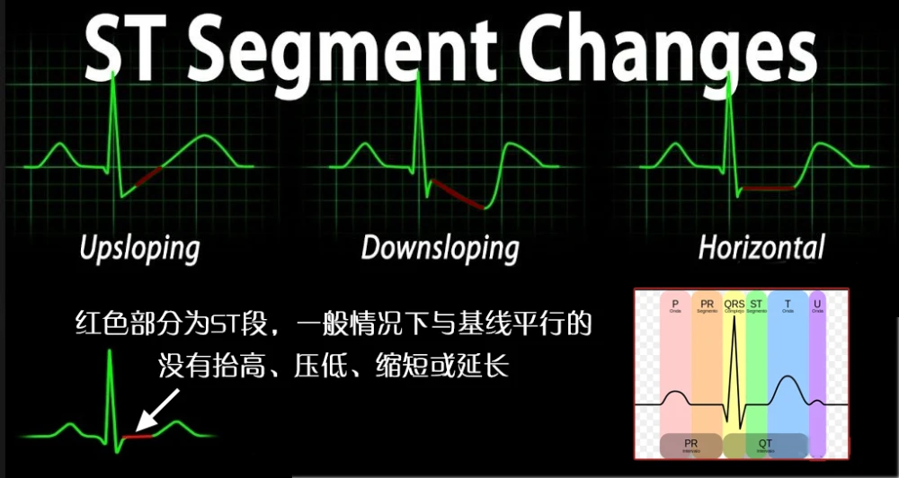 心电图q波改变原因_心电图波形改变_心电图波形的改变的定义及分析